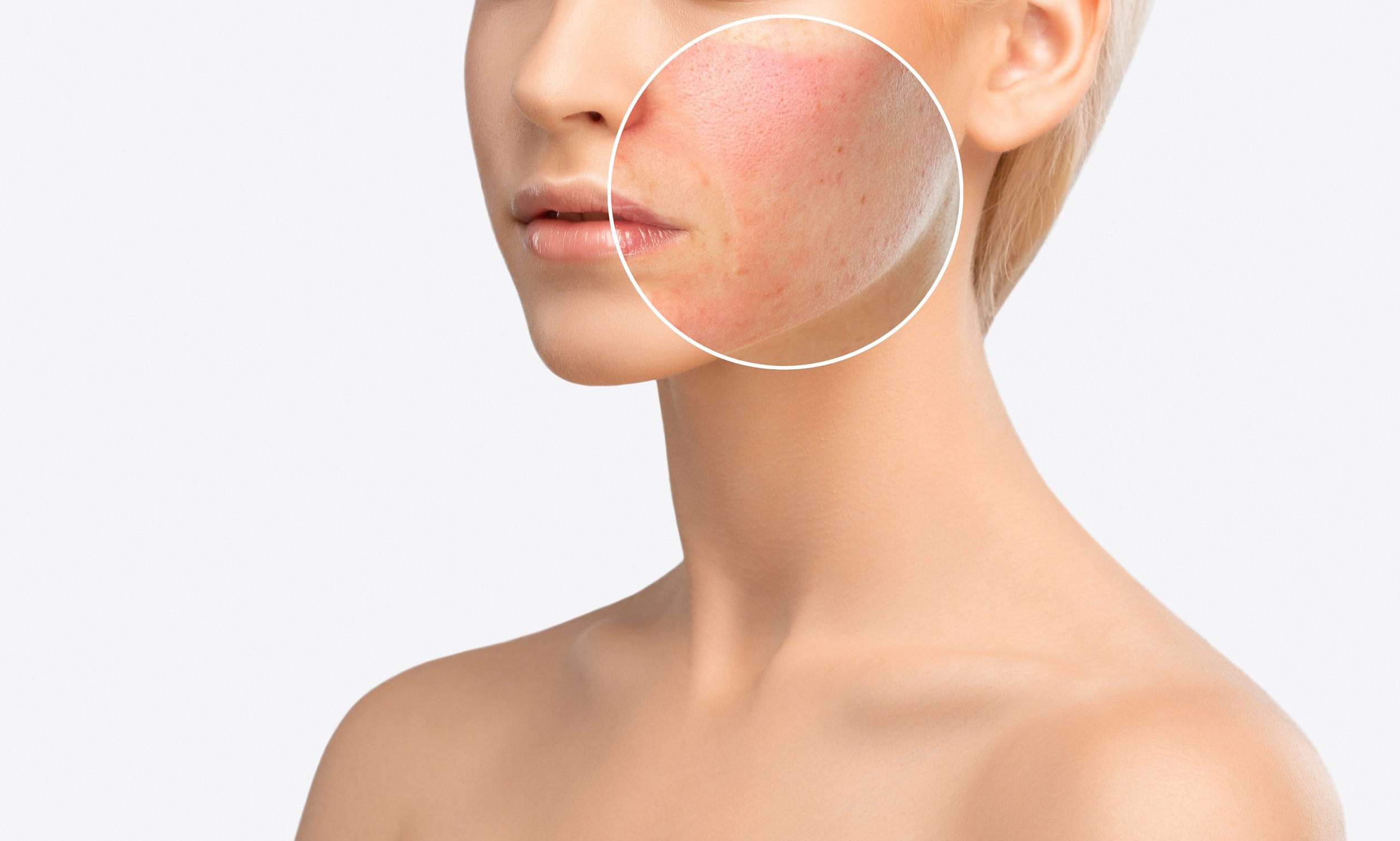 Acne and Skin Infections