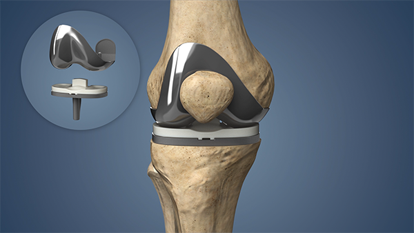 Joint Replacement Surgery