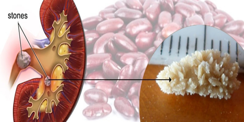 Kidney Stone Removal