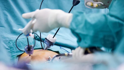 Laparoscopic Gallbladder Surgery
