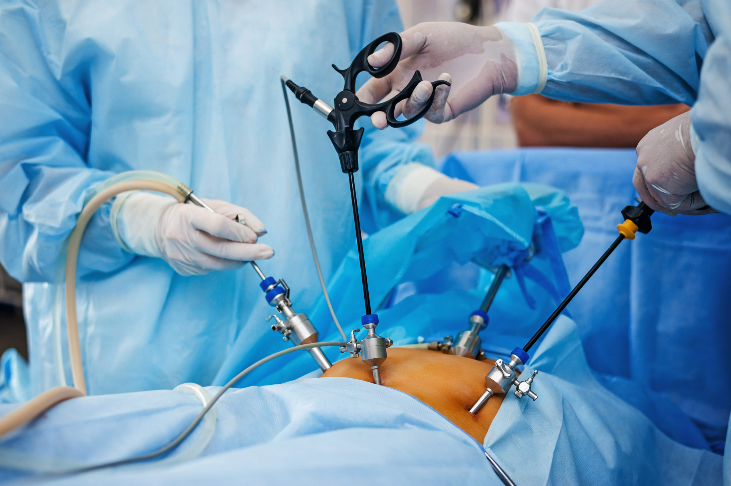 Laparoscopy Surgery