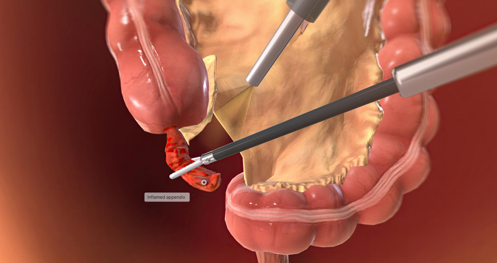 Appendectomy Surgery