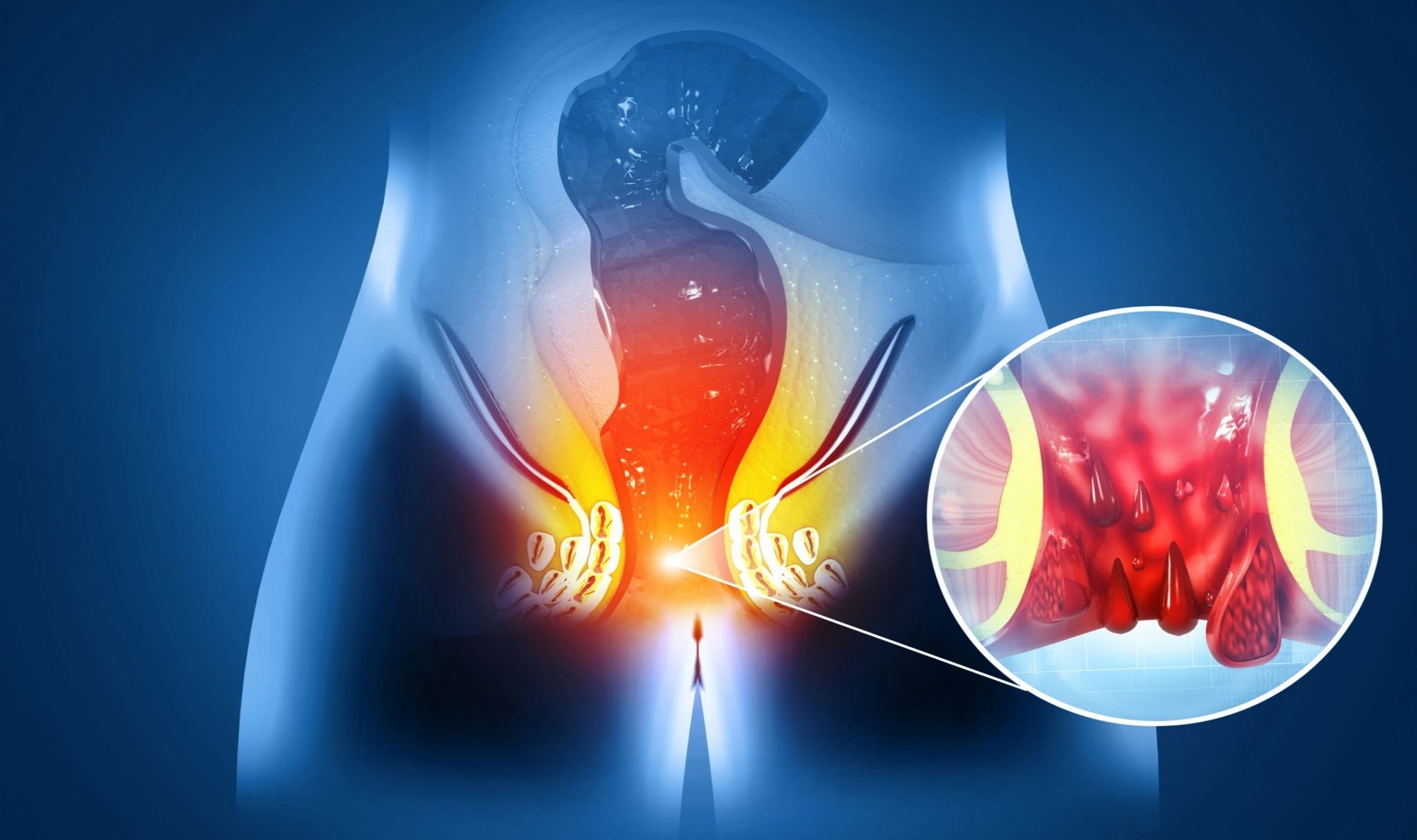 Piles and Fistula Surgery